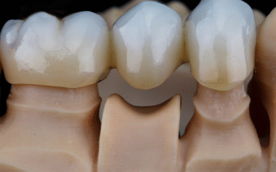 Transform Your Smile with Dental Crowns and Bridges Solutions